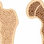 Consulta sobre medicamento para osteoporose termina hoje