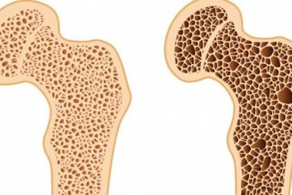 Consulta sobre medicamento para osteoporose termina hoje