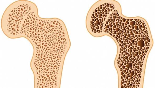 Consulta sobre medicamento para osteoporose termina hoje