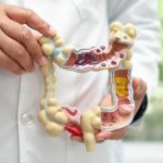 Saúde anuncia distribuição de testes para rastrear câncer de intestino