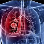 Estudo aponta proteínas ligadas ao risco de hipertensão pulmonar