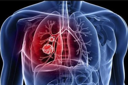 Estudo aponta proteínas ligadas ao risco de hipertensão pulmonar