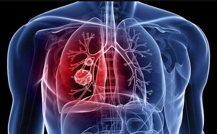 Estudo aponta proteínas ligadas ao risco de hipertensão pulmonar